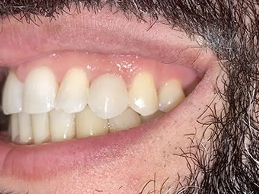 Composite Bonding, after