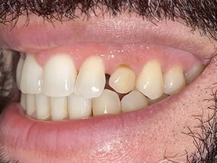 Composite Bonding, before