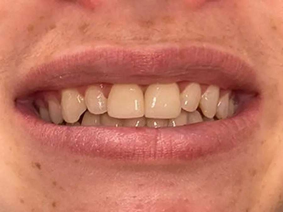 Porcelain Veneers & Crowns, after