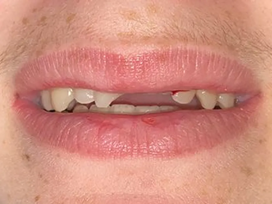 Porcelain Veneers & Crowns, before