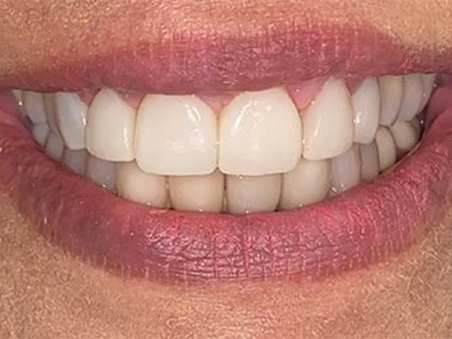 Porcelain Veneers, after