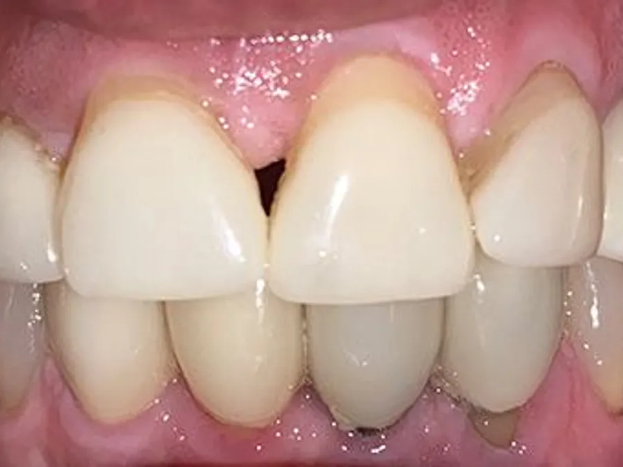 Porcelain Veneers, before