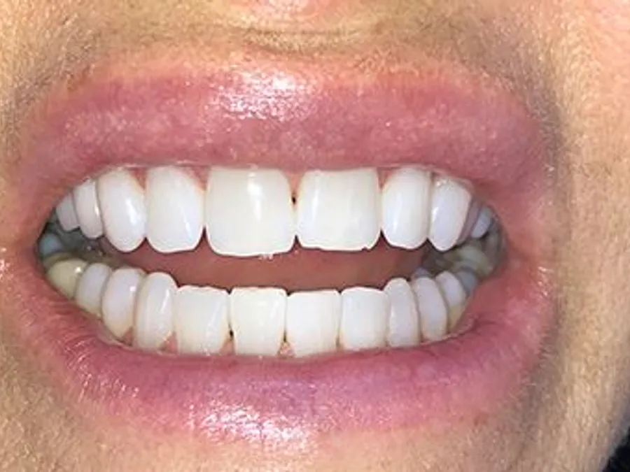 Professional Teeth Whitening, after