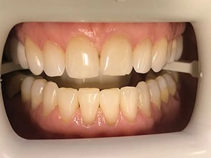 Professional Teeth Whitening, before