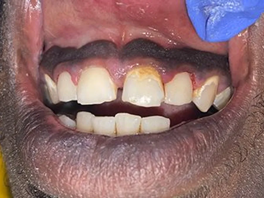 Composite Bonding, after