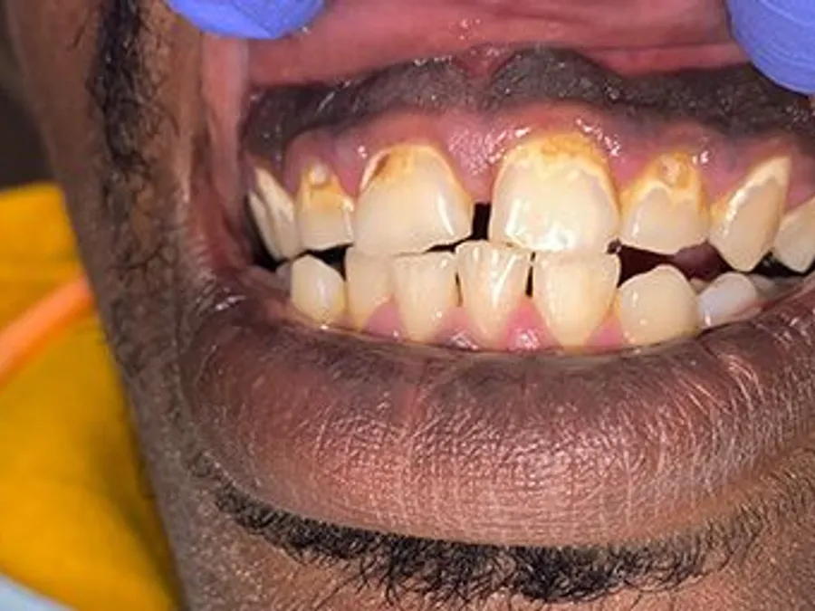 Composite Bonding, before
