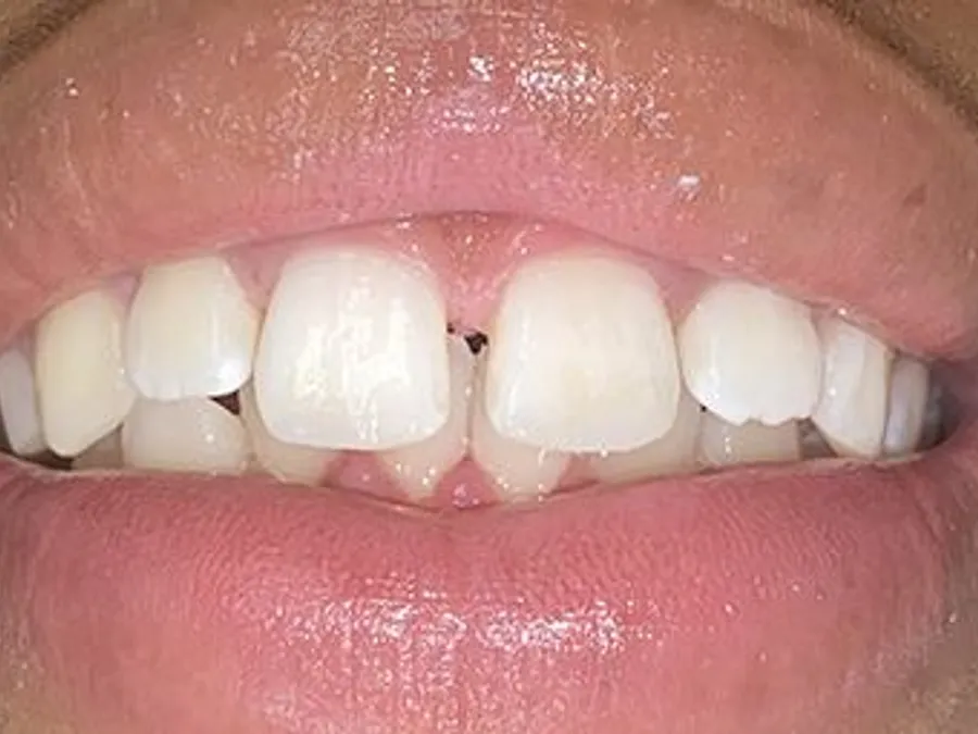 Composite Bonding, after