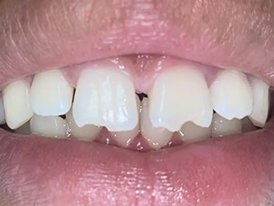 Composite Bonding, before