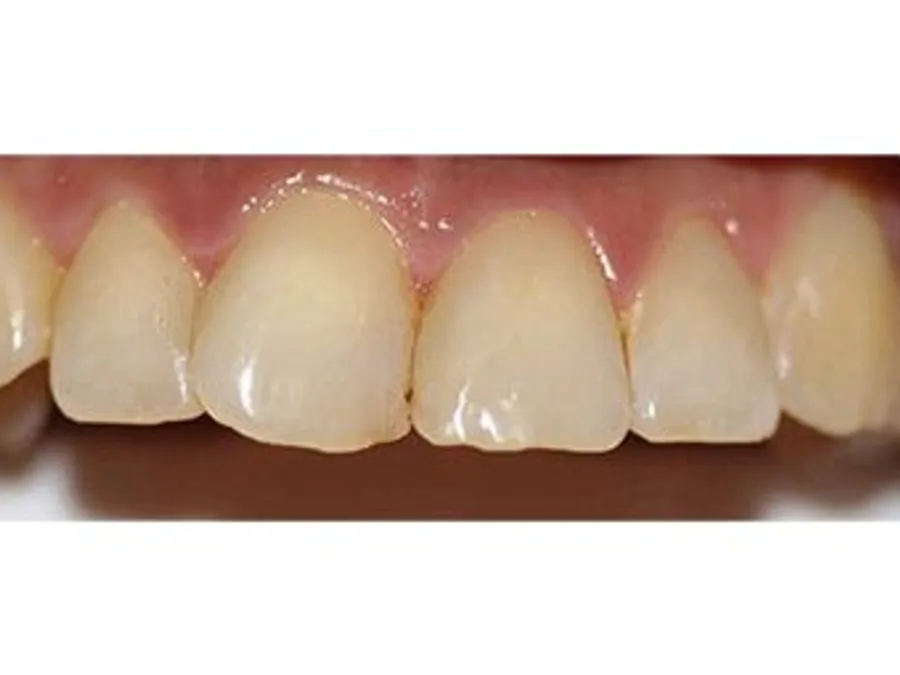Tooth-Colored Filling, after