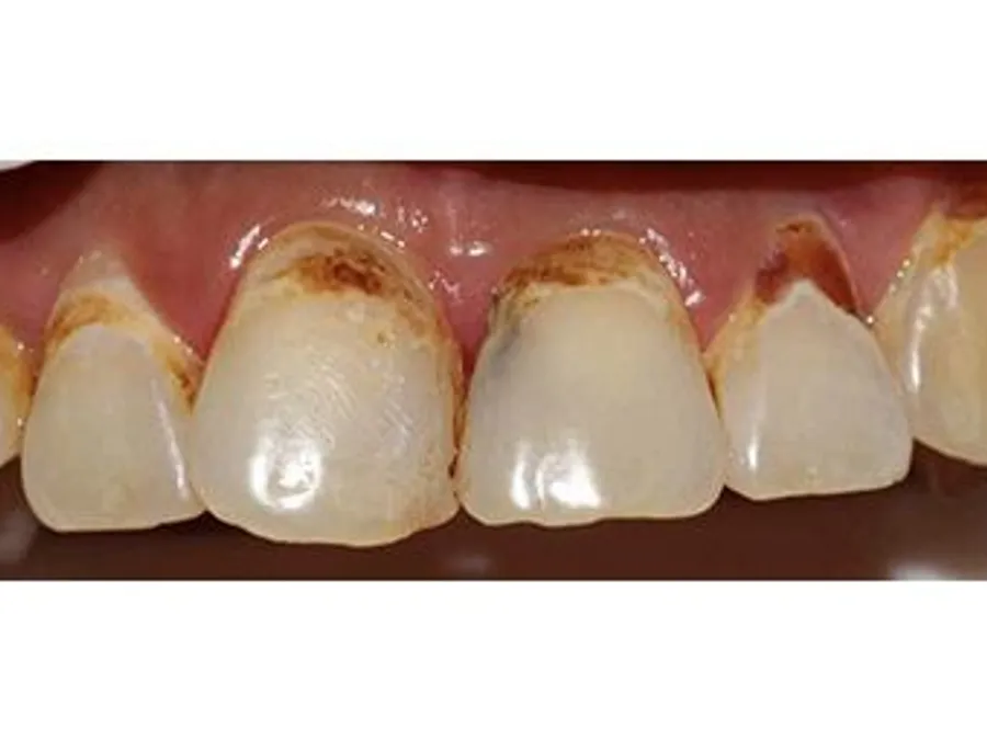 Tooth-Colored Filling, before