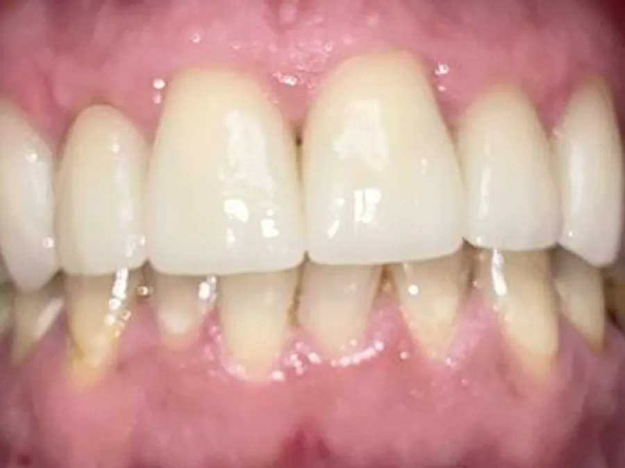 Full Mouth Reconstruction, after
