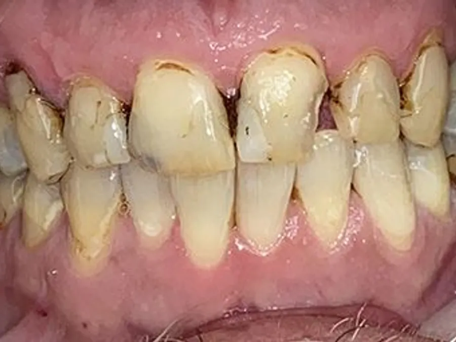 Full Mouth Reconstruction, before