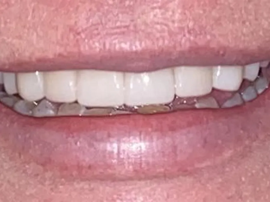 Porcelain Veneers & Crowns, after