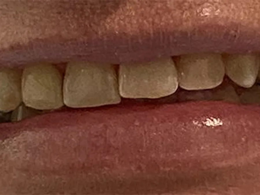Porcelain Veneers & Crowns, before