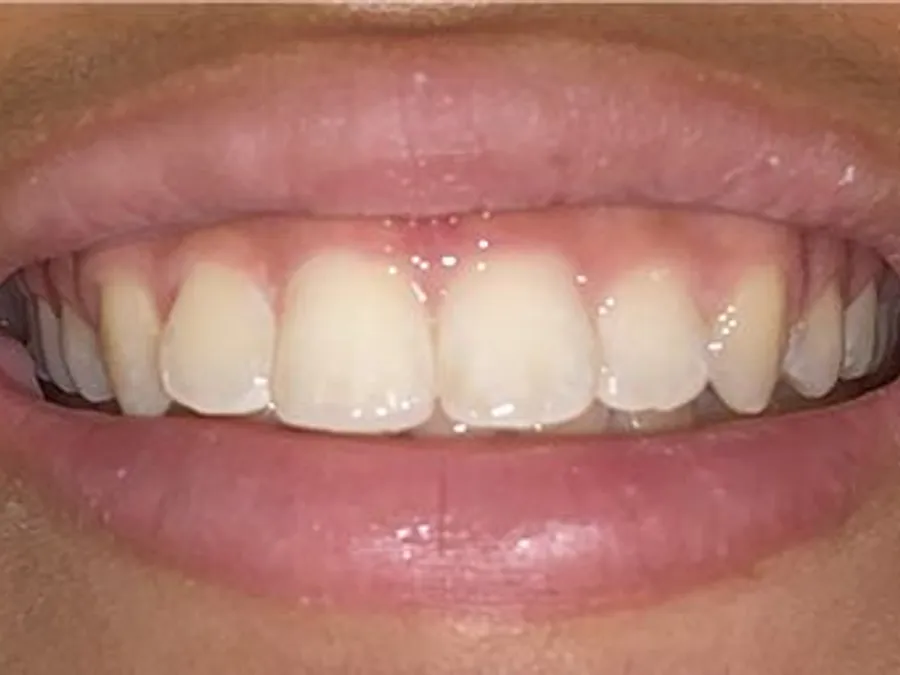 Composite Bonding, after