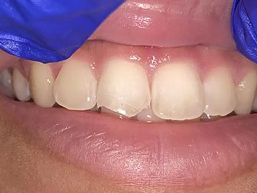 Composite Bonding, before