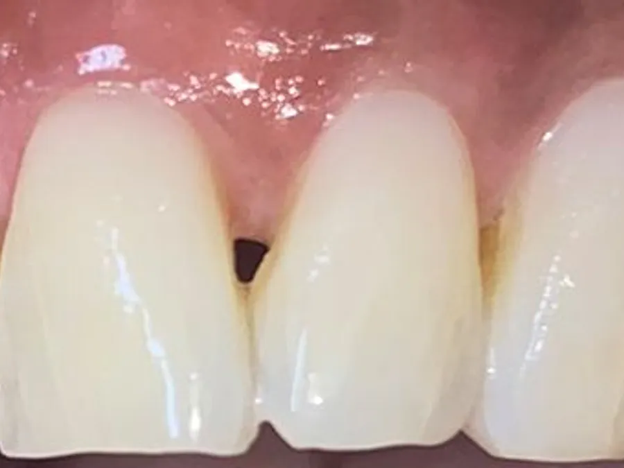 Composite Bonding, after