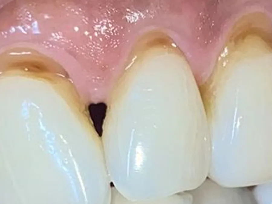 Composite Bonding, before