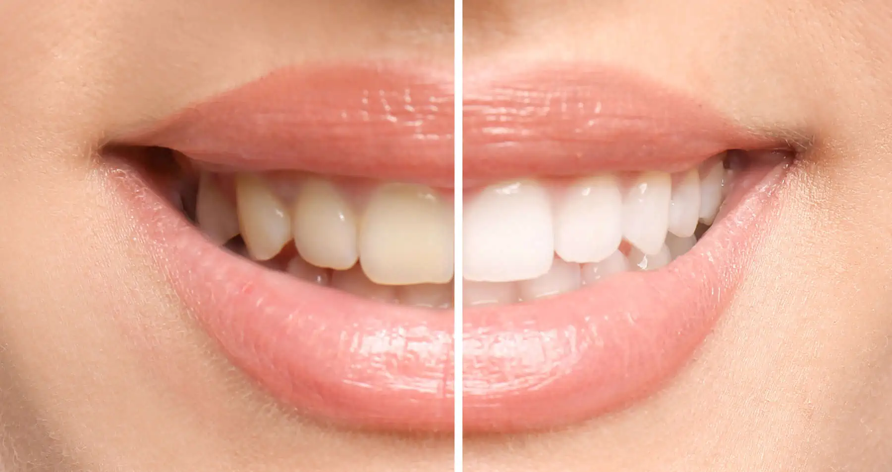 Professional teeth whitening