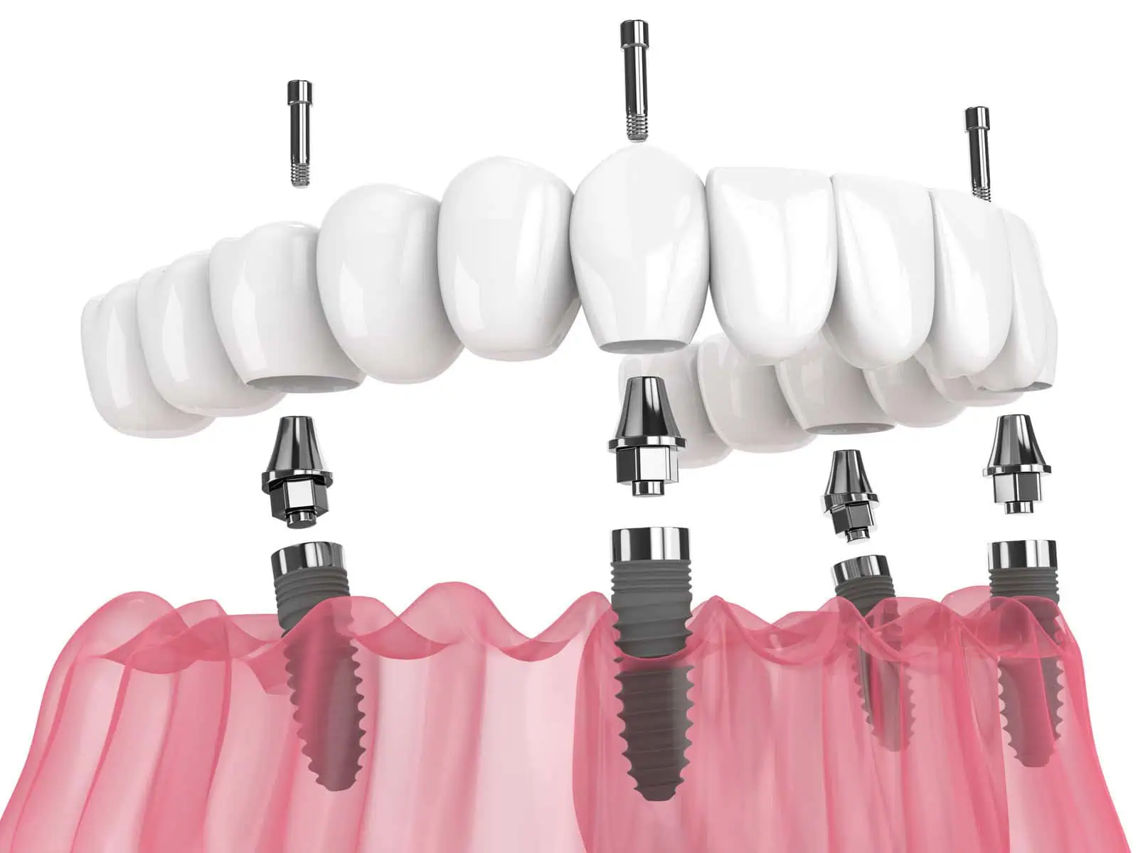 All-on-4 Implants