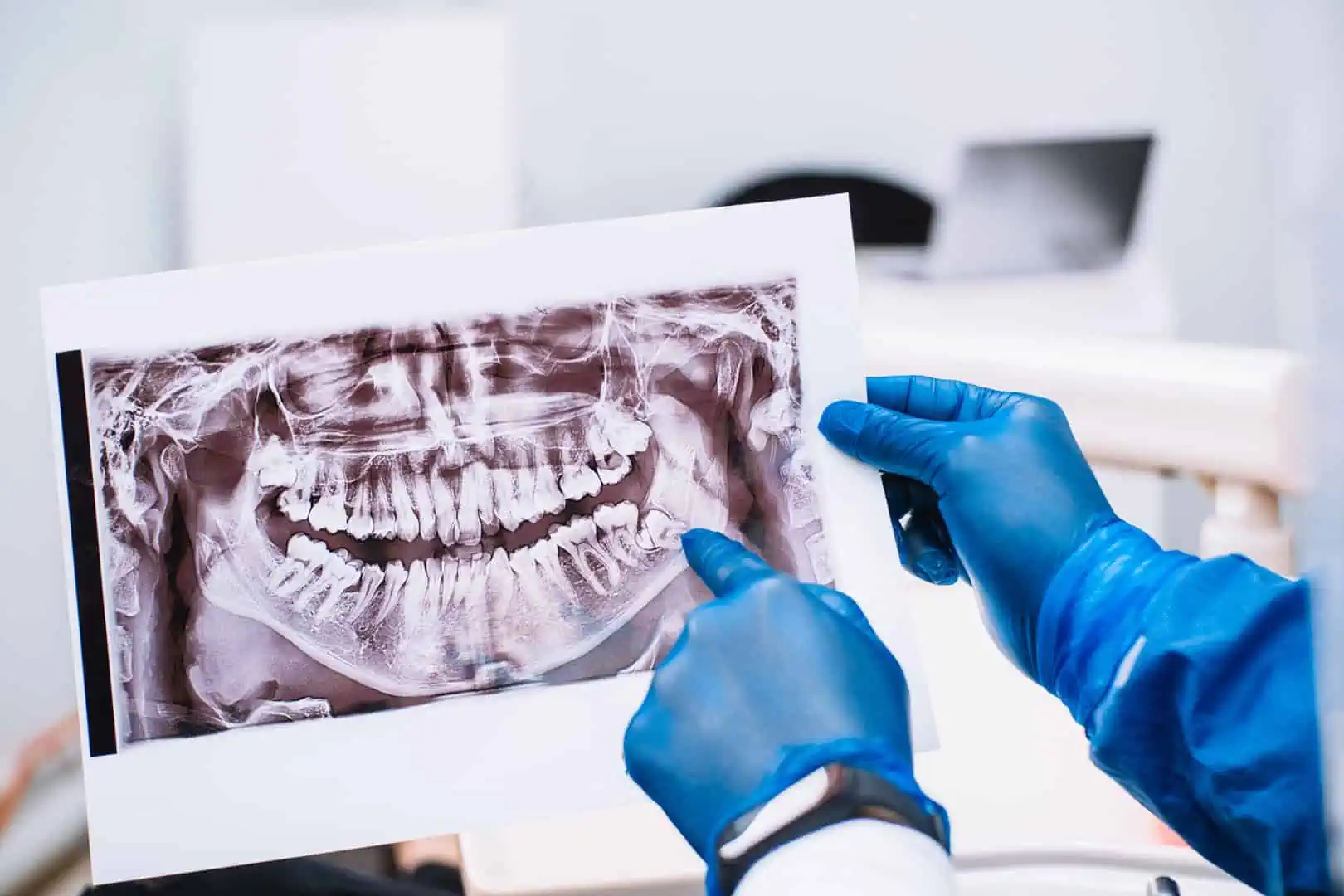 Wisdom Teeth Removal